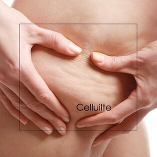 Am Oberschenkel ist Cellulite zu sehen.